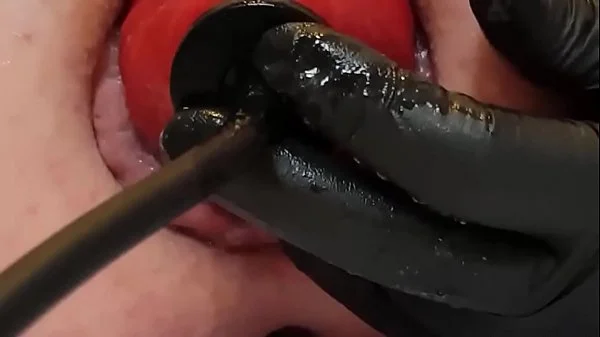 Contender For Biggest Prolapse (Male Warning!)