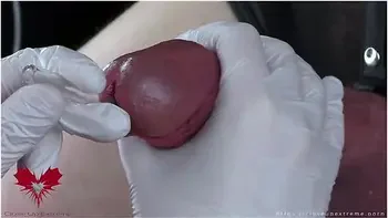 Perfect Extraction Of Sperm Directly From The Urethra. Close-up Of The Glass Straw Sounding